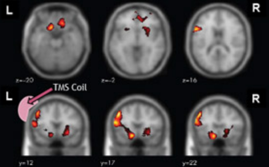 SPECT Scan, Pittsburgh Neurocare Center