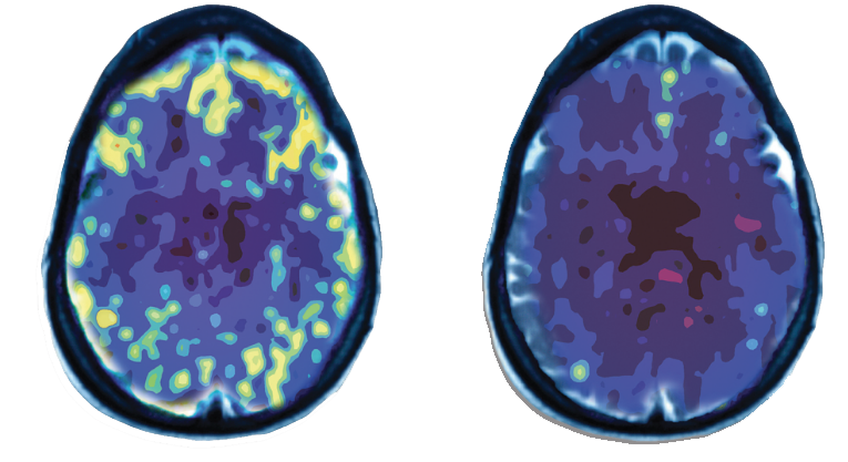 PET Scan Brain Activity Levels, Pittsburgh Neurocare Center